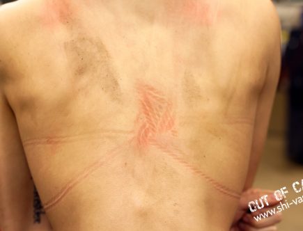 Cocos nackter Rücken mit deutlichen, rötlichen Abdrücken von Seilen und Knoten, teilweise sind dunkle Flecken von Seilabrieb zu sehen.